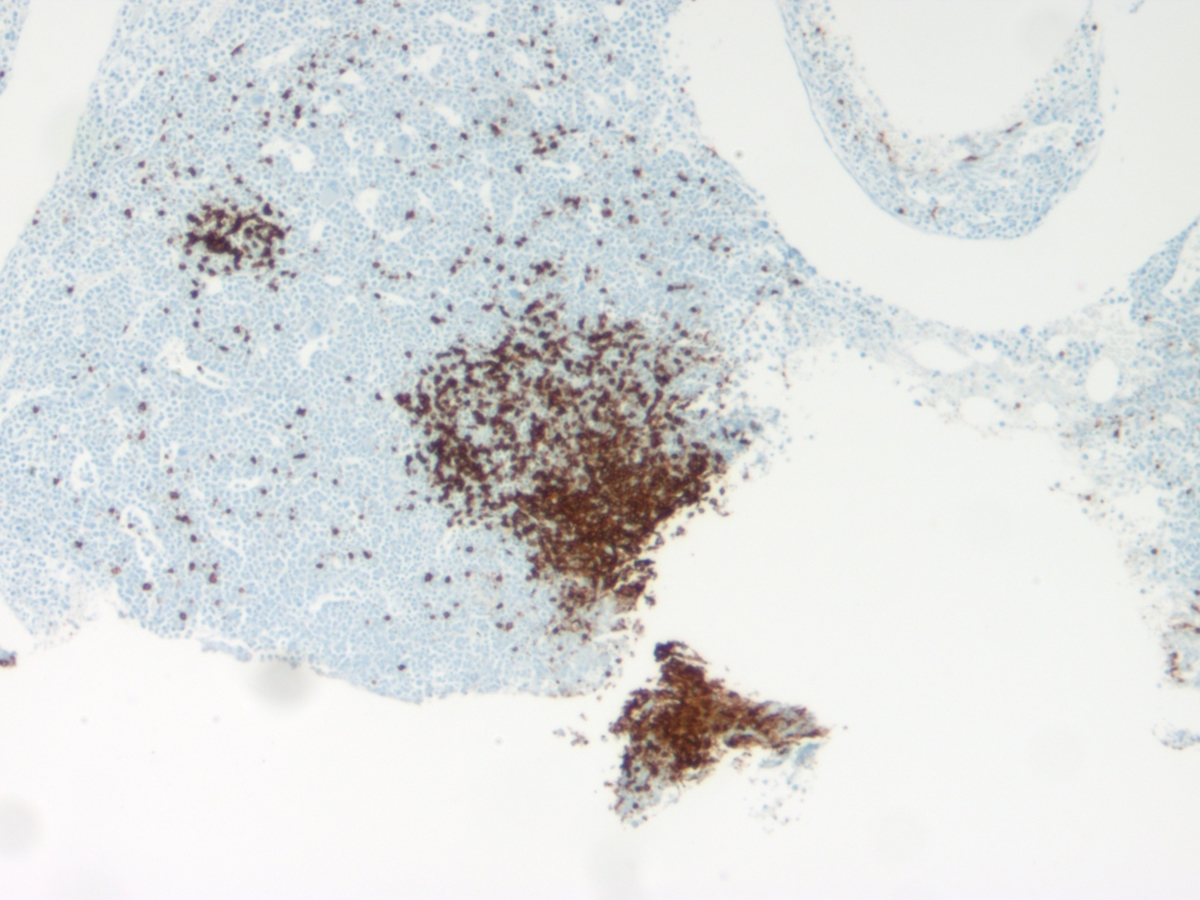 Bone marrow biopsy CD20